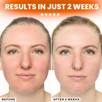 Morra GlowForm™ LED Therapy Mask